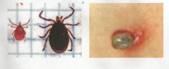 À gauche aspect d’une tique / à droite la tique après morsure À gauche aspect d’une tique / à droite la tique après morsure