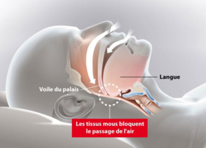 LE SYNDROME D’APNÉE DU SOMMEIL (SAS) LE SYNDROME D’APNÉE DU SOMMEIL (SAS)