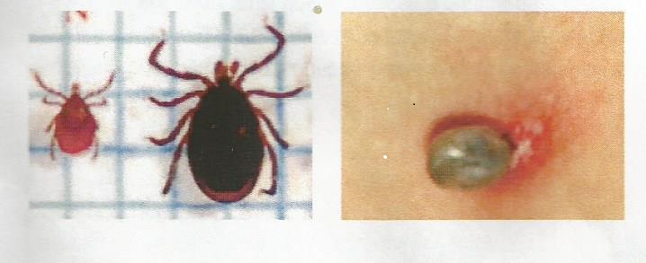 À gauche aspect d’une tique / à droite la tique après morsure À gauche aspect d’une tique / à droite la tique après morsure